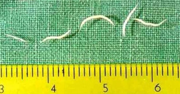 Pinworms-ը փոքր երեխաների ճիճուների ամենատարածված տեսակն է 