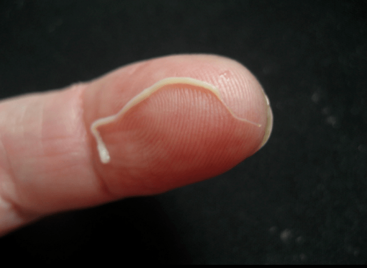 կլոր որդ մակաբույծ մարդու մարմնից